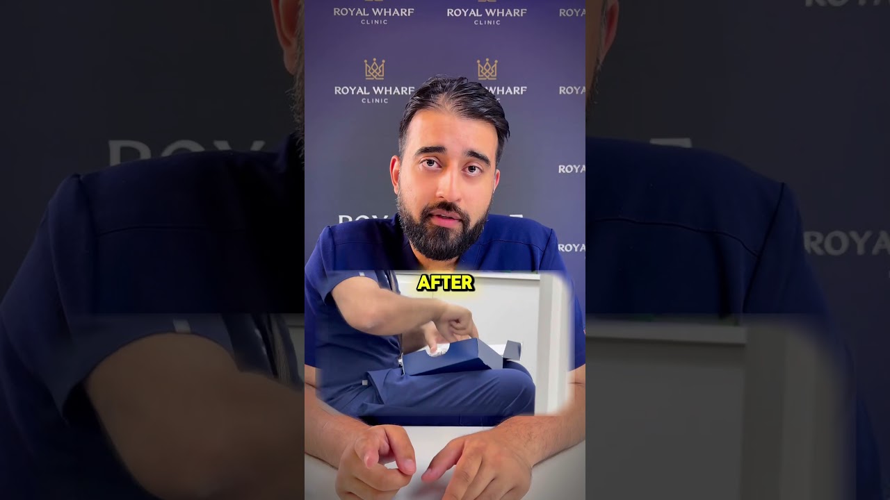 Chris Bumsteads Hair Transplant #hairtransplant part 2