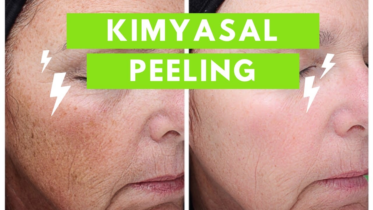 Evde Kimyasal peeling Nasıl Yapılır?