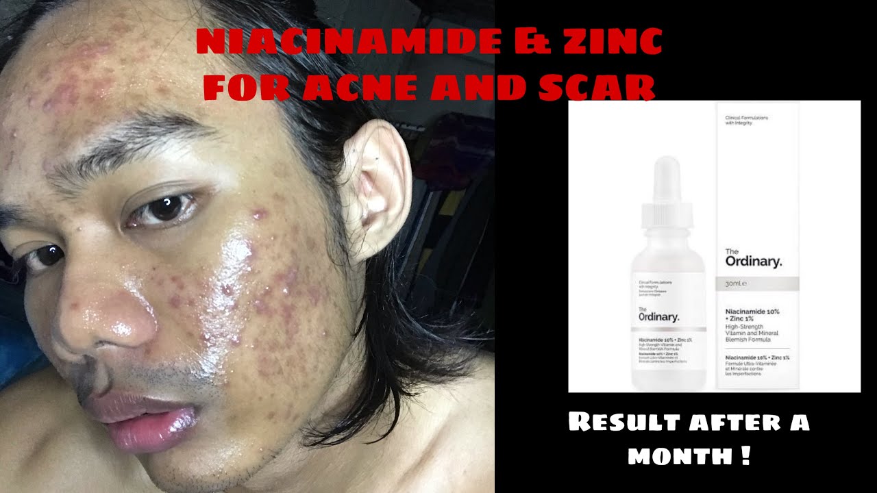 I TRIED THE ORDINARY NIACINAMIDE AND ZINC FOR A MONTH | THE RESULT IS...?