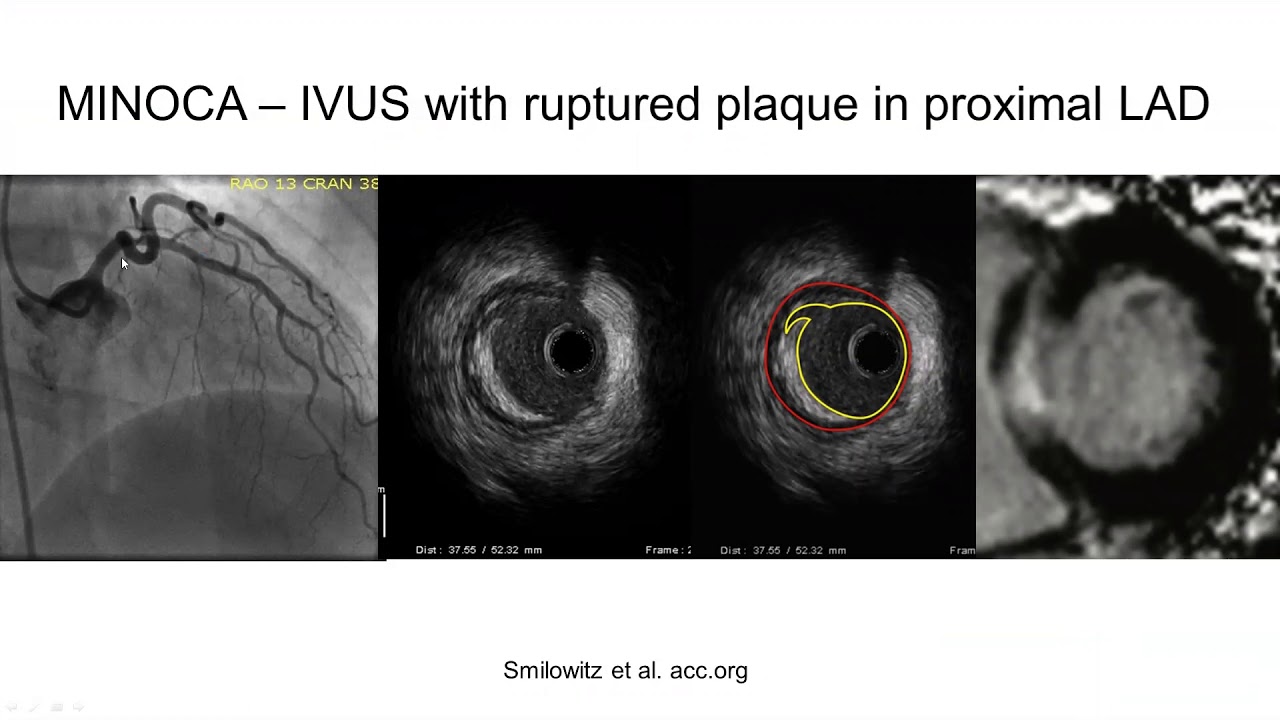 Algorithm for evaluation of the MINOCA patient - Yader Sandoval, MD
