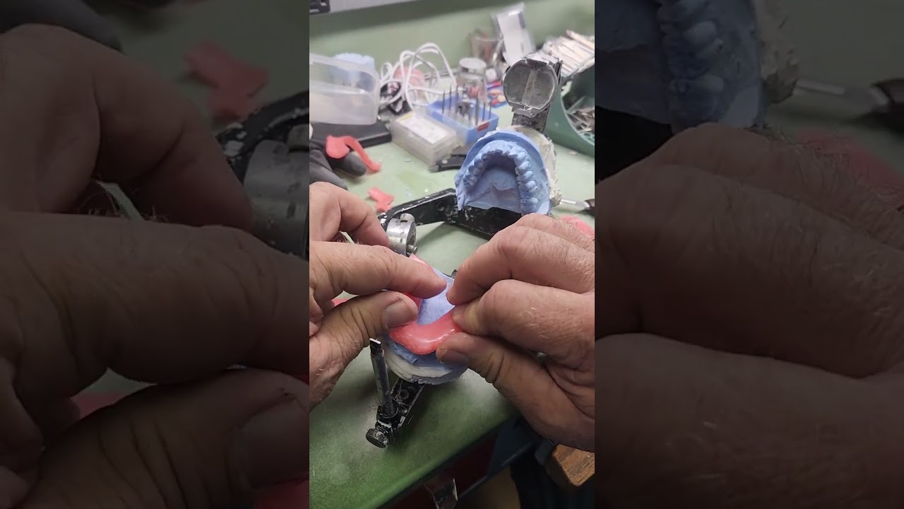 making a maxillary orthotic heat processed part 1