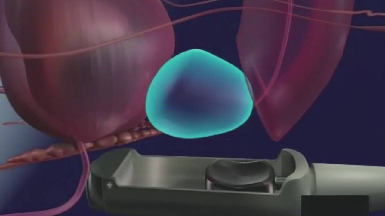 Non-invasive option to treat prostate cancer