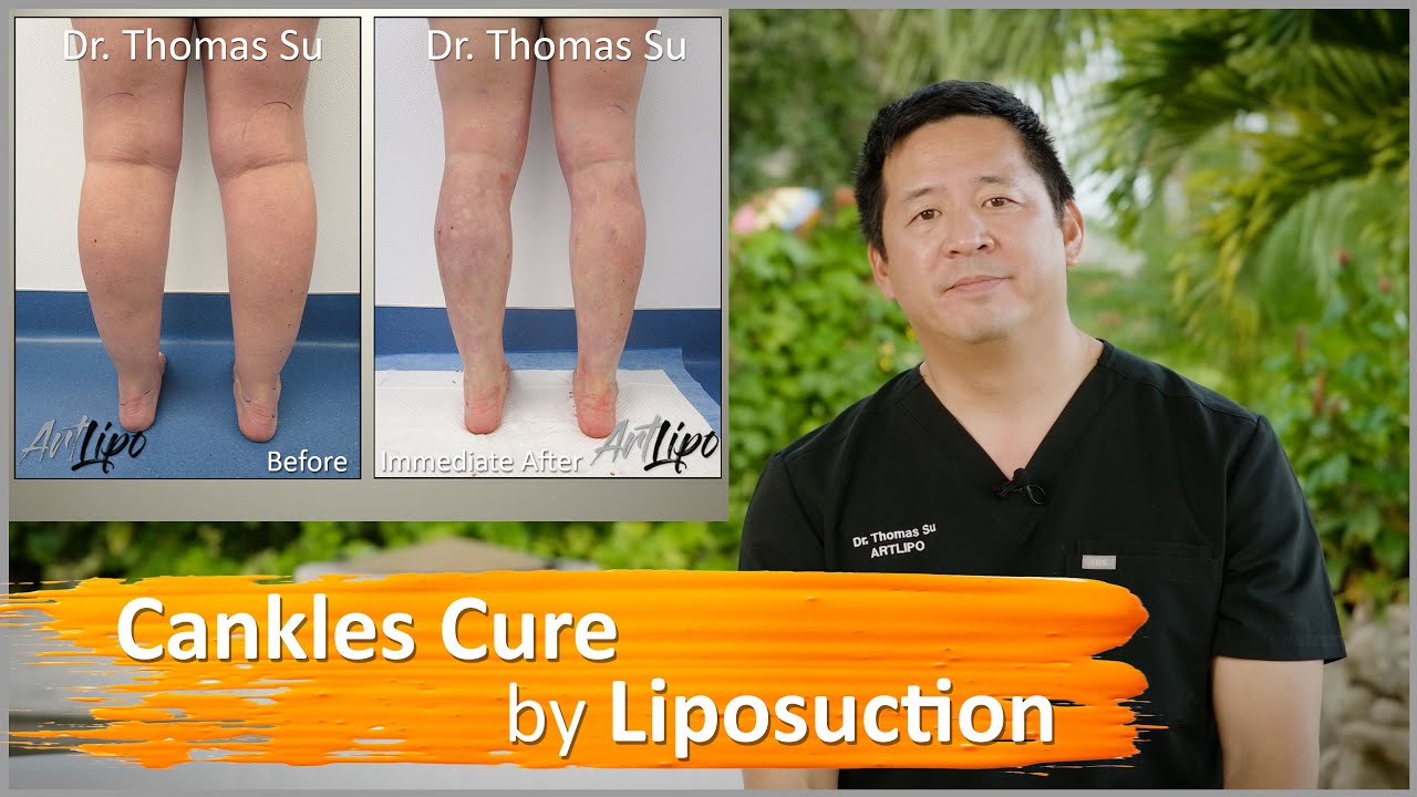 Cankles Cure | Leg Liposuction | Immediate Results | Lipedema Surgery | Artlipo | Expert Dr. Su
