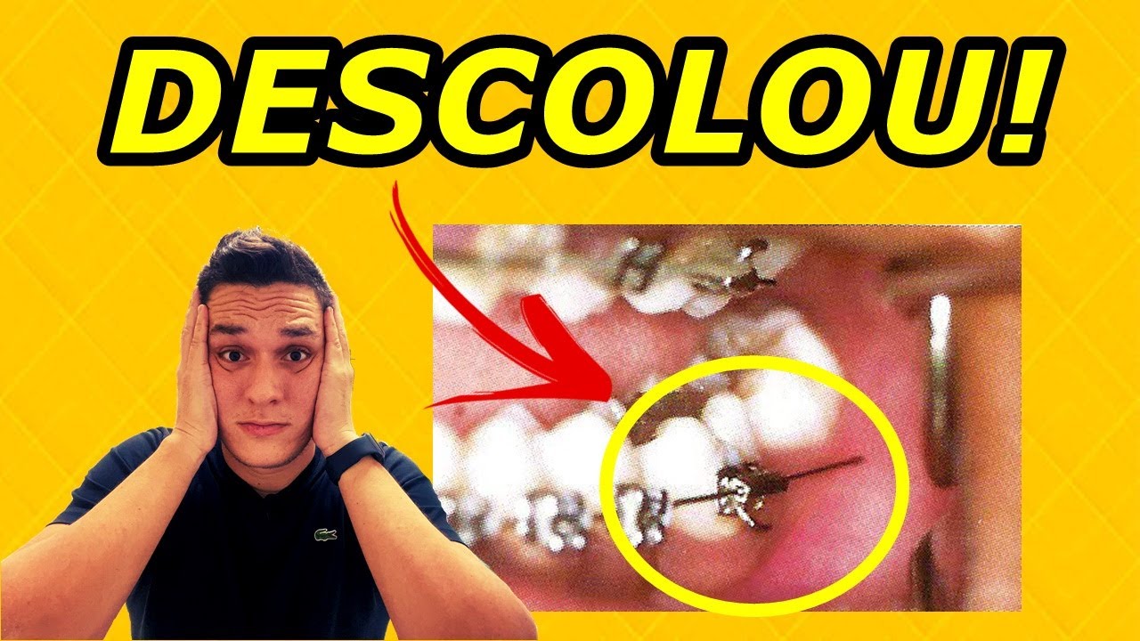 O BRACKET DO SEU APARELHO DESCOLOU OU QUEBROU? O QUE VOCÊ DEVE FAZER?