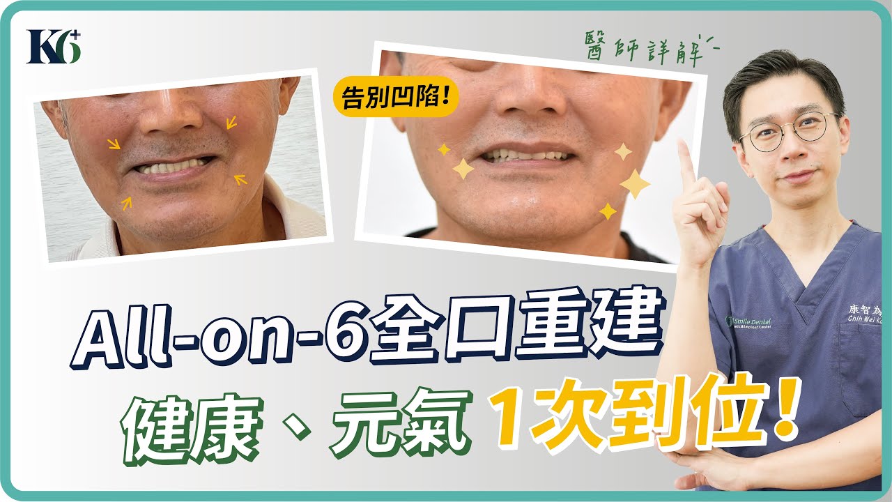 All-on-6 全口重建：缺牙太久也不用擔心？康智為醫師告訴你All-on-6的優勢