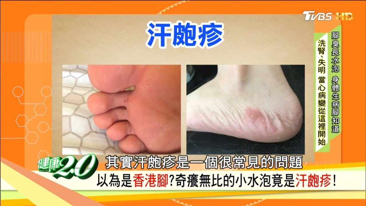 腳癢抓一抓就好？抓出傷口潰爛是糖尿病警訊！以為「香港腳」竟是汗皰疹！健康2.0