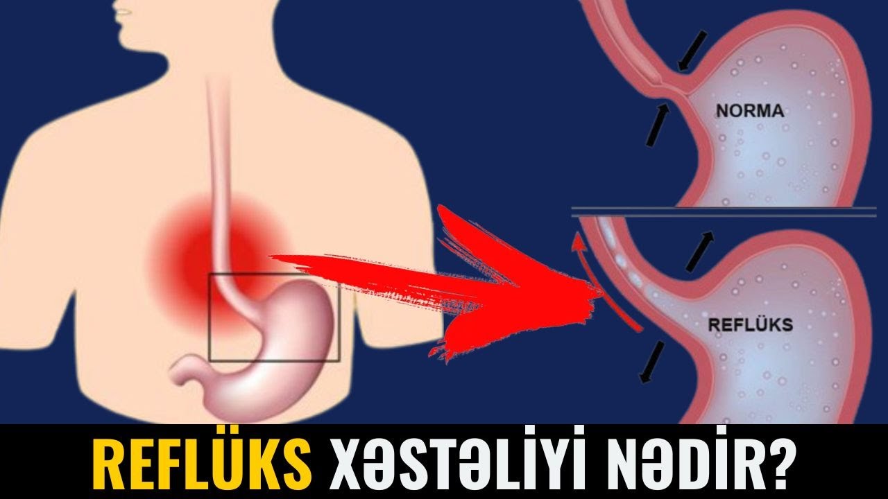 Uşaqlarda REFLÜKS Xəstəliyi - Yaranma səbəbləri,  Müalicəsi