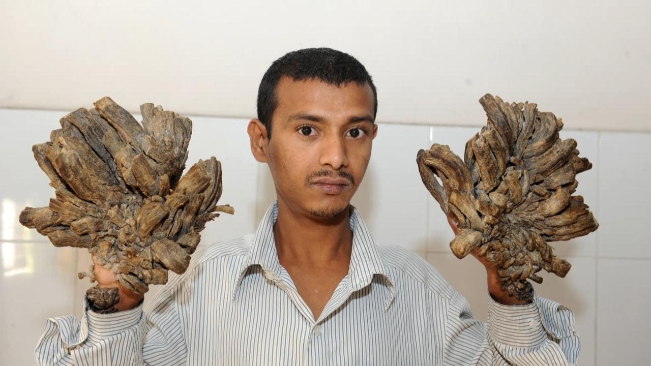 Surgeries Give &ldquo;Tree Man&rdquo; His Life Back