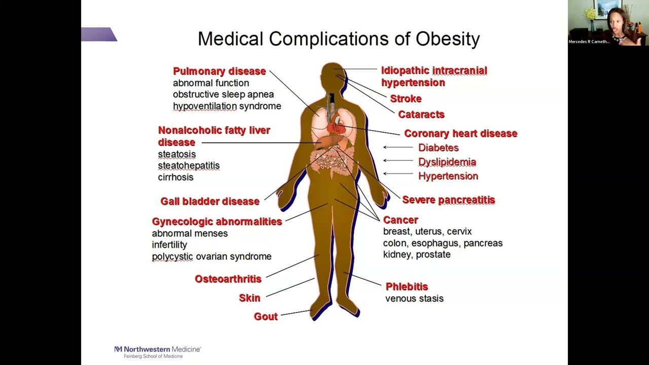5/12/2023: Challenges with Obesity with Chronic Disease in the Population
