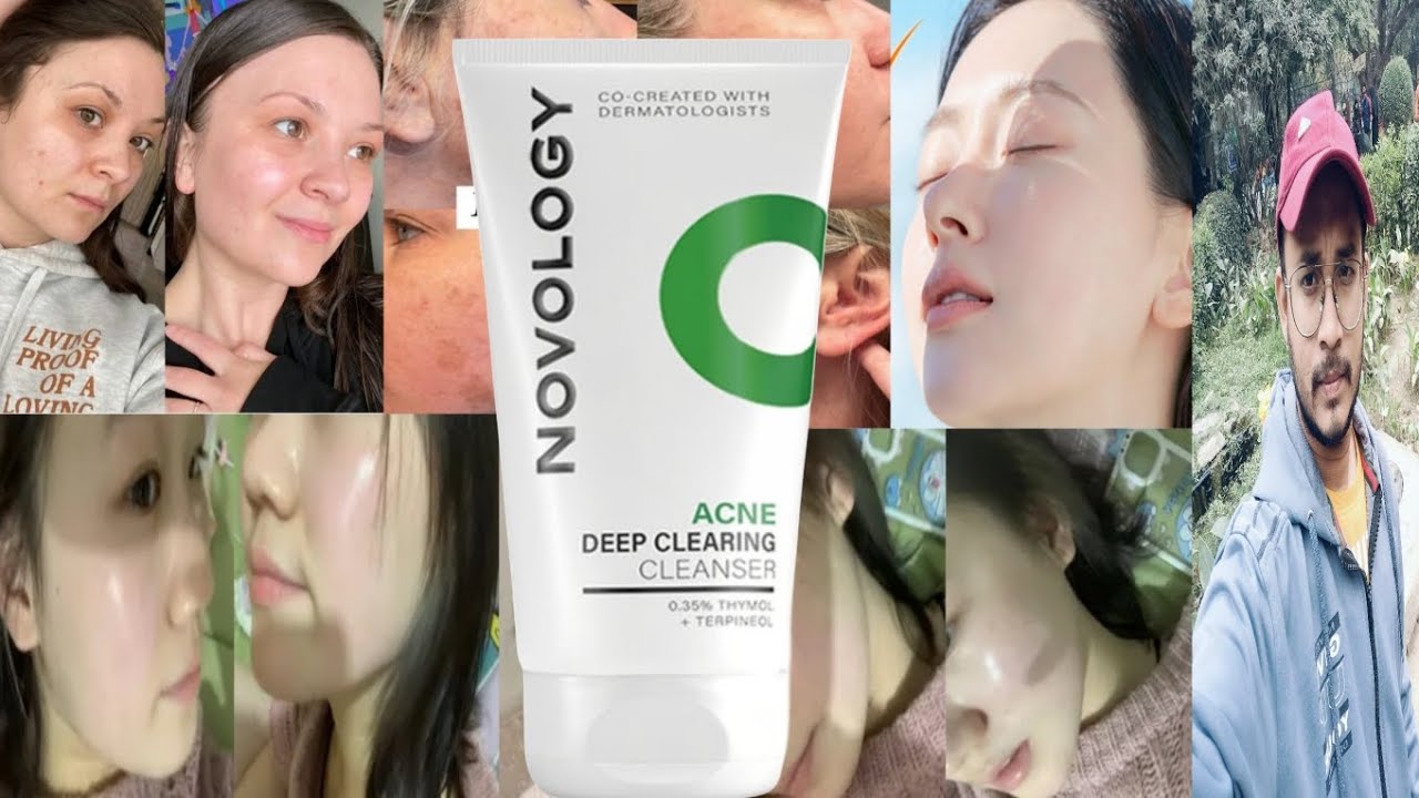 Novology Acne Deep Clearing Cleanser | Honest Review
