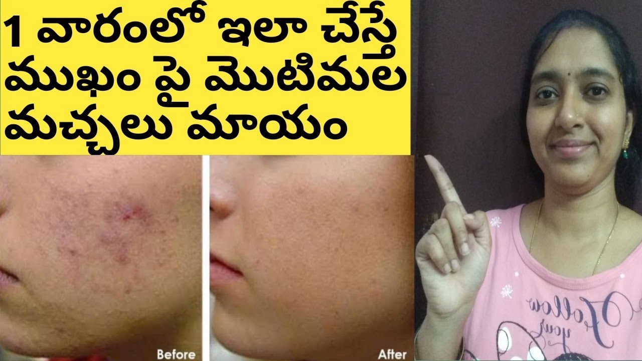 How To Remove Pimples Marks From Face Naturally In Telugu/How To Remove Pimples Marks At Home Telugu