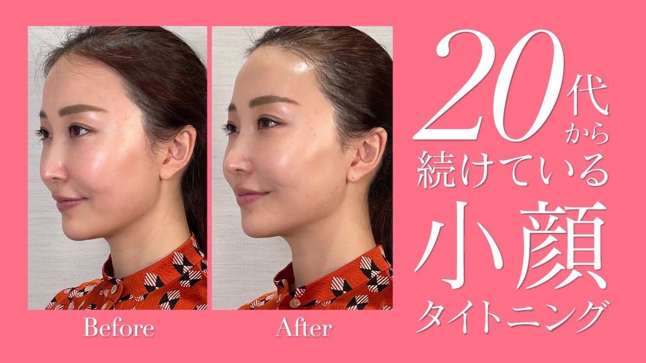 【小顔効果】20代から続けている美容「サーマクール」をしてきました😊