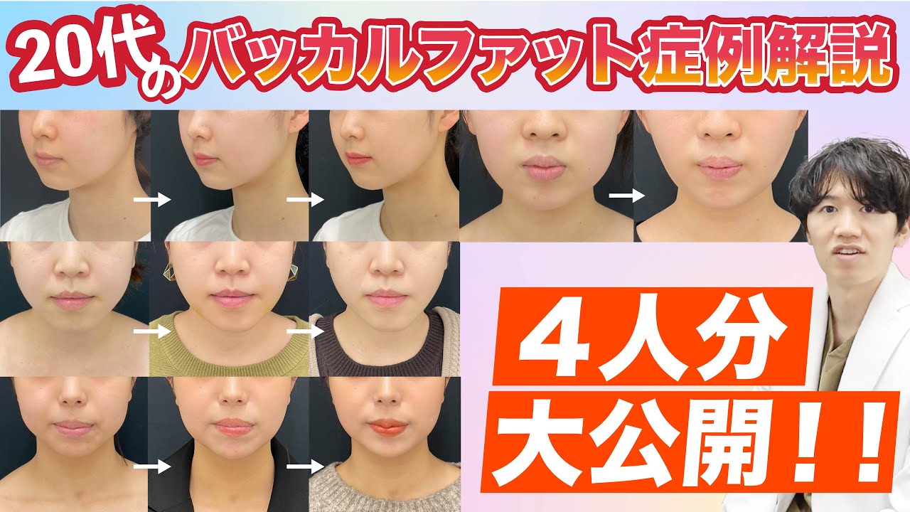 【20代女性】バッカルファット症例徹底解説！【整形】