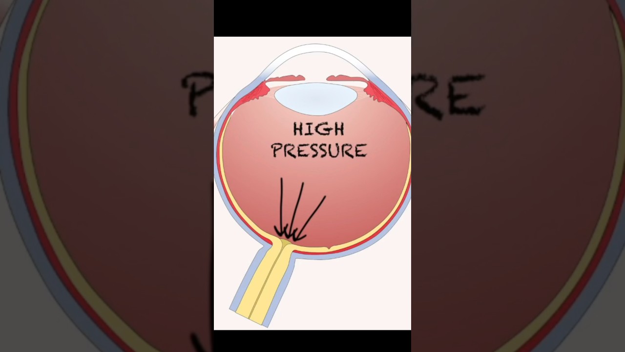 What is Glaucoma?  #glaucoma