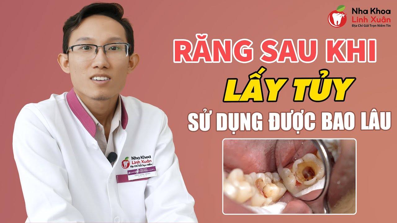 Răng sau khi lấy tủy còn sử dụng được bao lâu thời gian?
