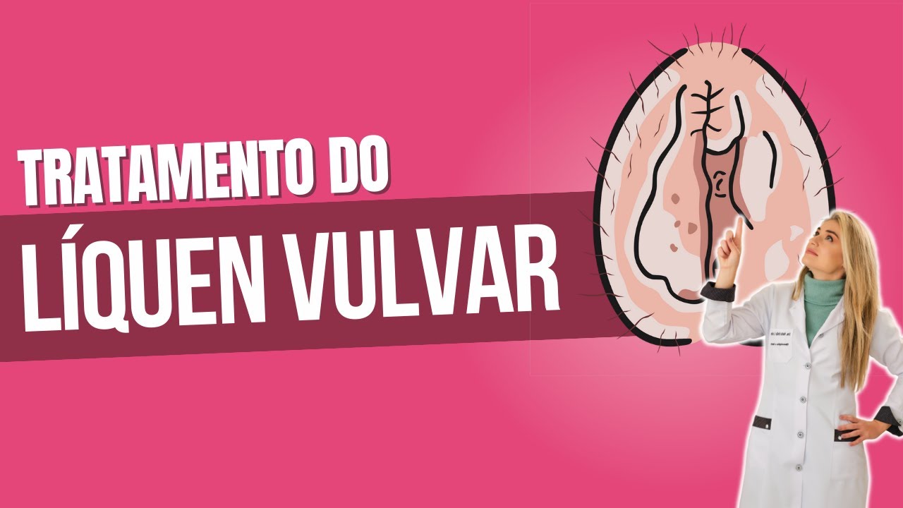 ACABE COM O LÍQUEN VULVAR DE VEZ! DICAS E TRATAMENTOS EFICAZES!