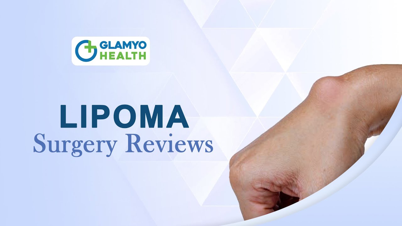 Lipoma Treatment Patient Review Video | Glamyo health