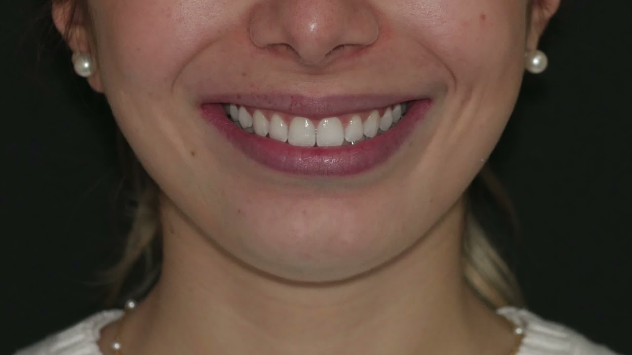 Seconda classe monolaterale, morso profondo e mediane deviate