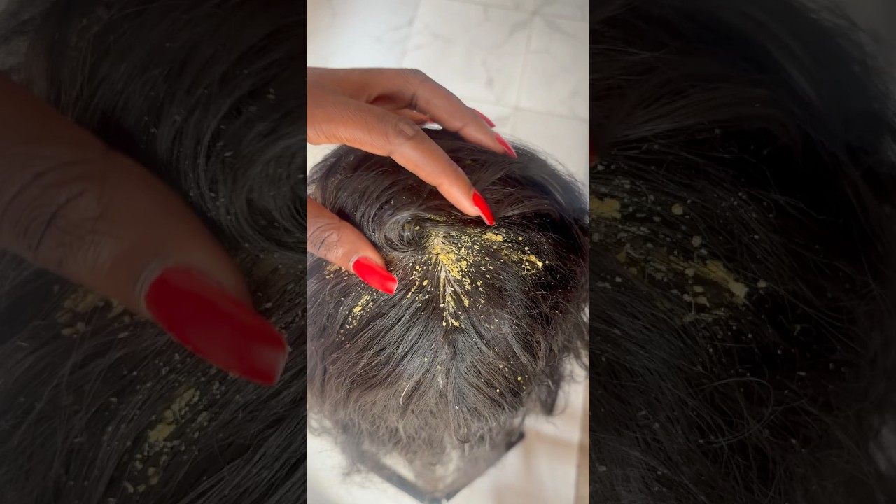 Relaxing dandruff scalp scratching with gum chewing sound  