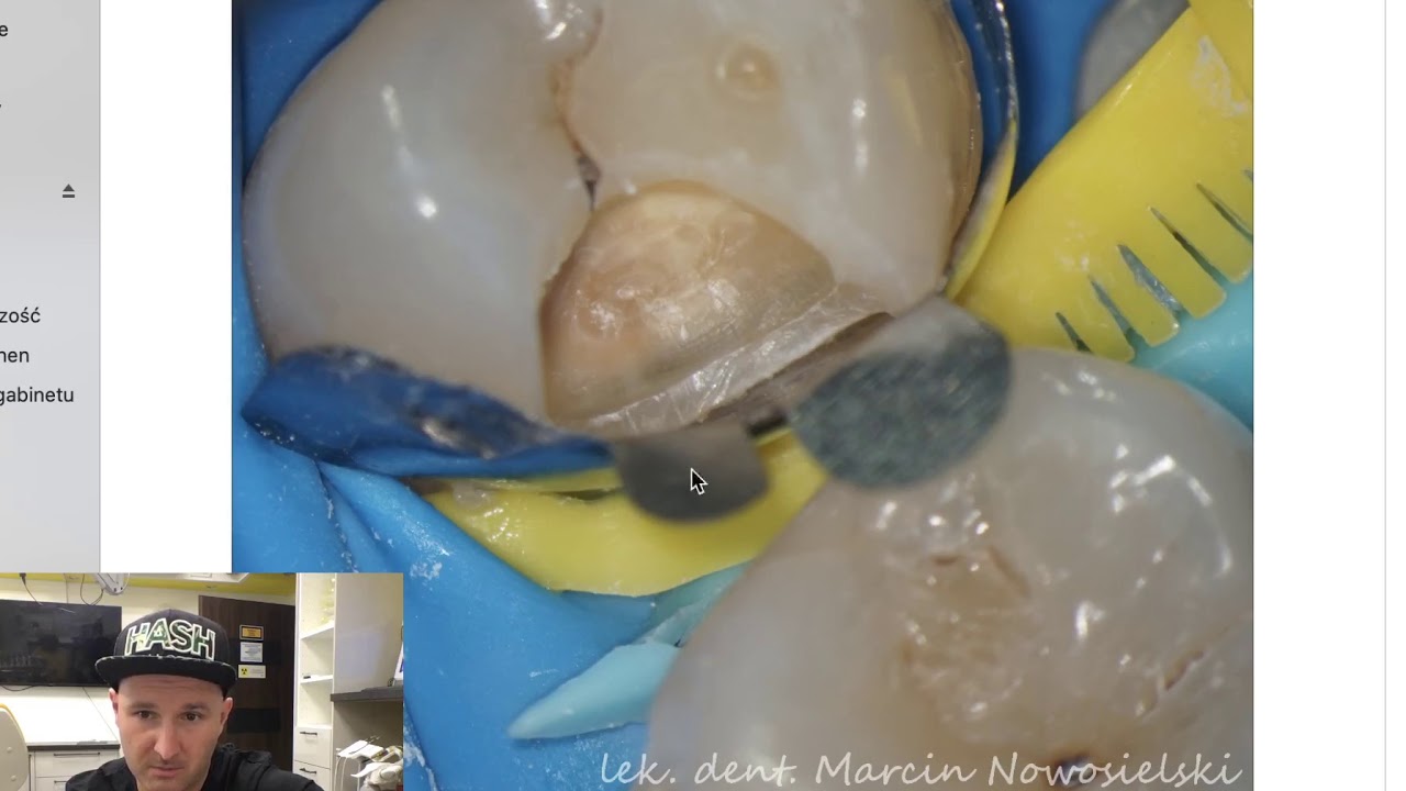 Dental MacGyver - Tips & Tricks e1 (pl): Trik z dwoma klinami przy brakującym zębie.