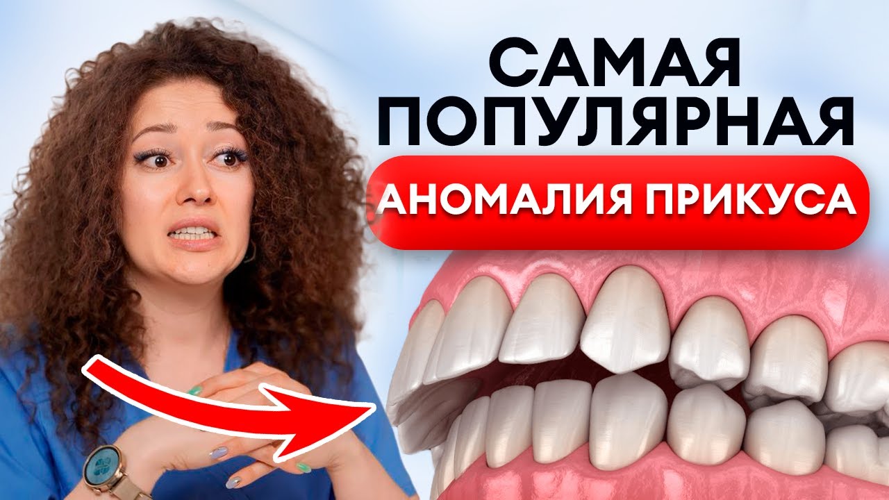 Самый ОПАСНЫЙ прикус у людей! / Как определить ДИСТАЛЬНЫЙ прикус и ВЫЛЕЧИТЬ его?