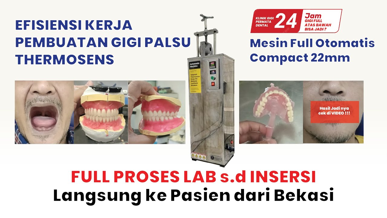 Proses Pembuatan Gigi Palsu Full Rahang Atas Bawah Pasien dari Bekasi 24 jam bisa Jadi ???!!!!