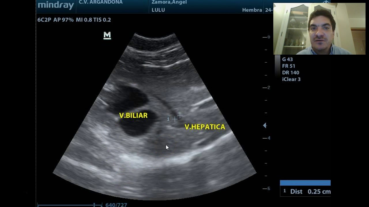 Ecografía abdominal parte 3