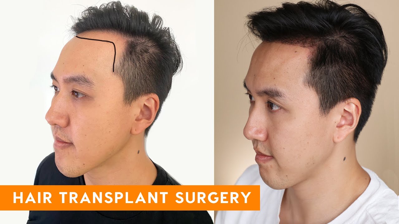 Hair Transplant Surgery | Best in Beauty