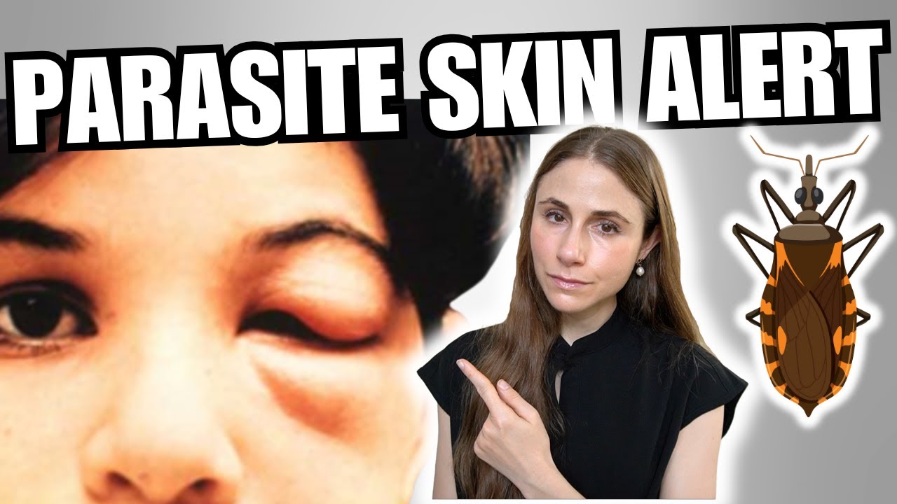 Chagas Disease in the U.S. | Skin Signs, Symptoms & Kissing Bug Risks Explained by a Dermatologist