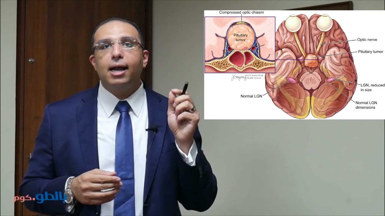 أورام الغدة النخامية و علاجها- دكتور أحمد زهران