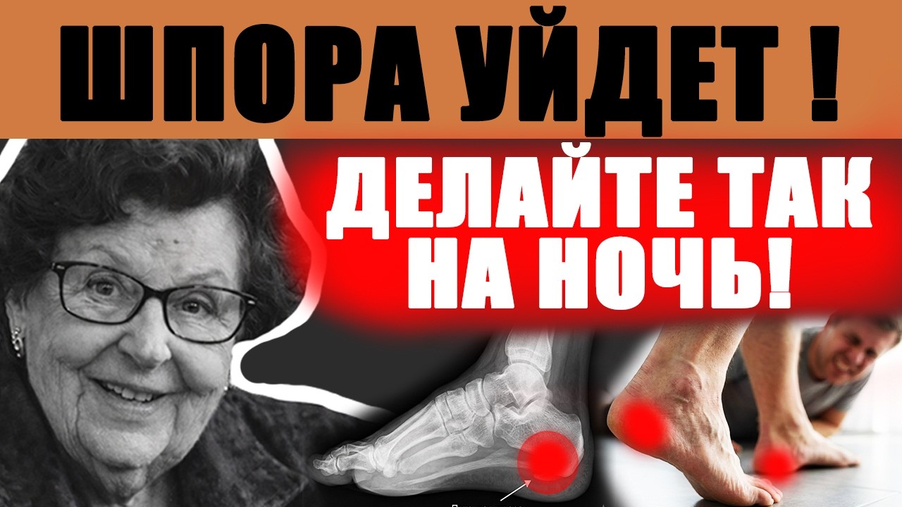«Пяточная шпора и Боль при первом шаге» ЧТО ДЕЛАТЬ?