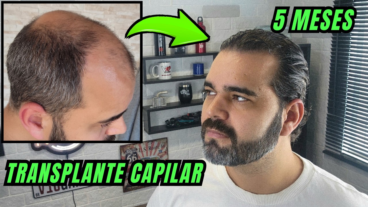 5° Mês do meu transplante capilar