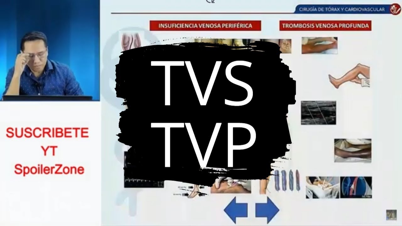 Trombosis Venosa Superficial y Profunda Qx Medic 