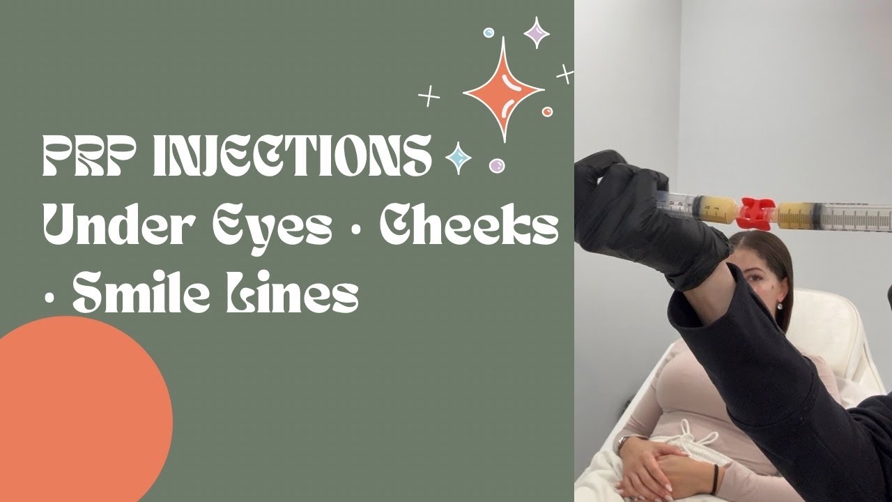 Platelet-Rich Plasma (PRP) Injections at 46 | Under Eyes, Cheeks & Smile Lines