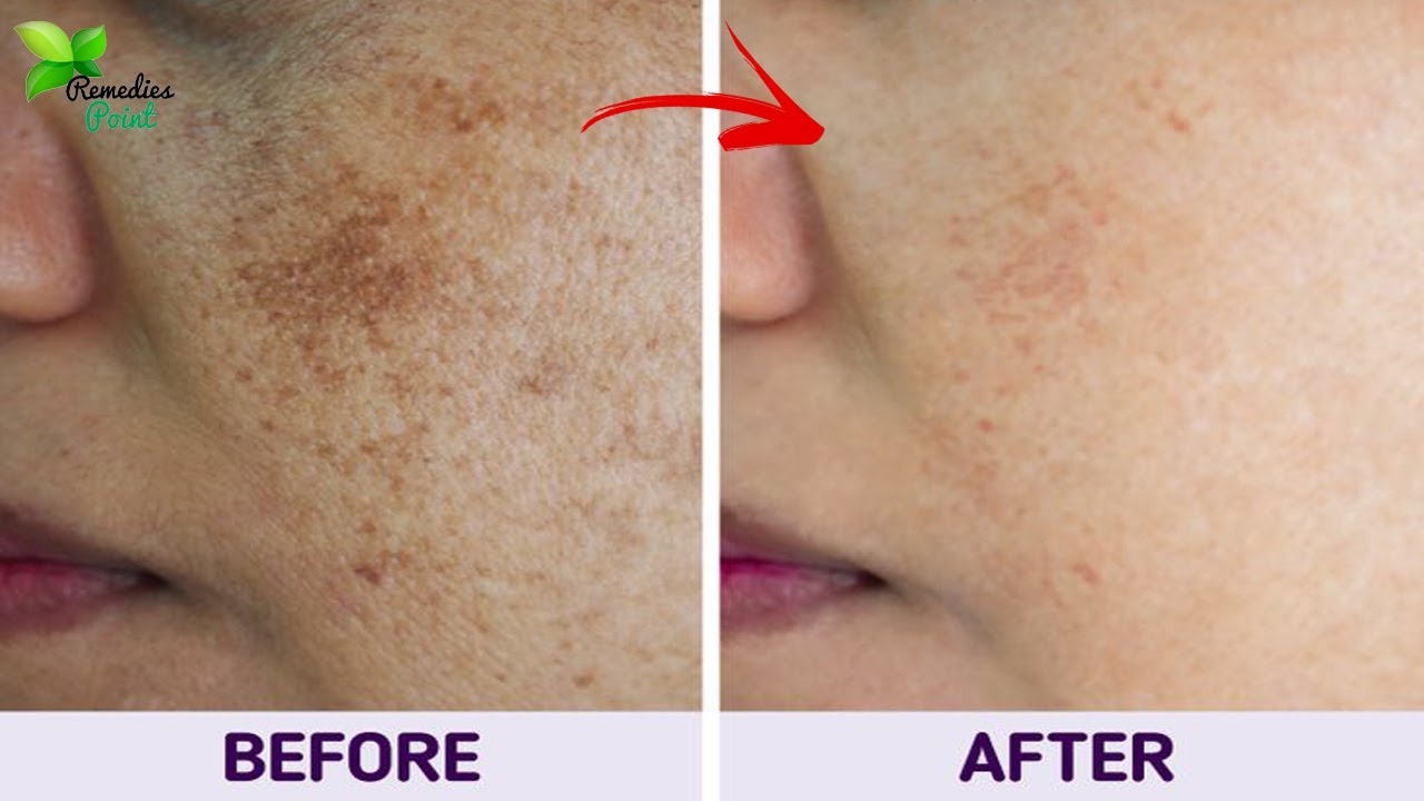 What Causes Skin Pigmentation, and 4 Ways to Avoid It