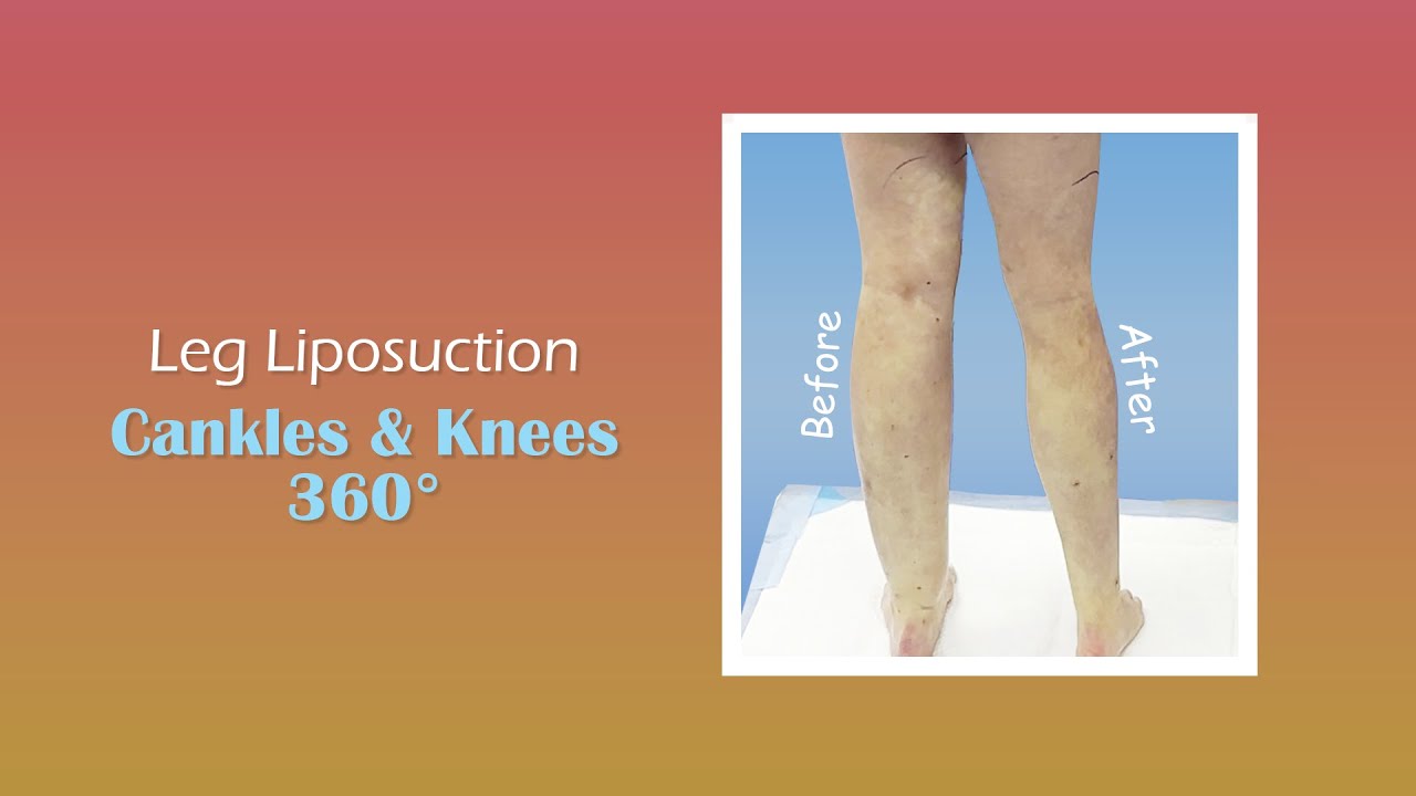 Cankles & Knees Liposuction | Immediate Results | Expert Dr. Thomas Su