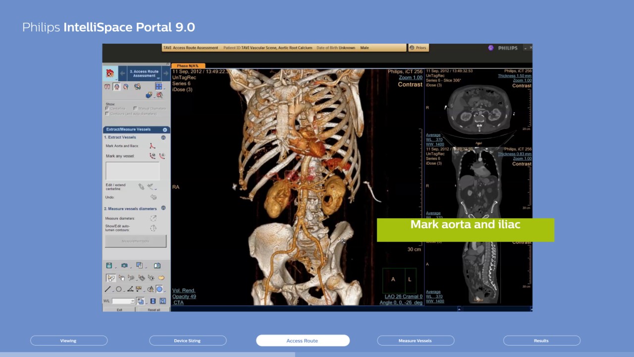 Philips IntelliSpace Portal 9.0, Clinical application CT TAVI planning