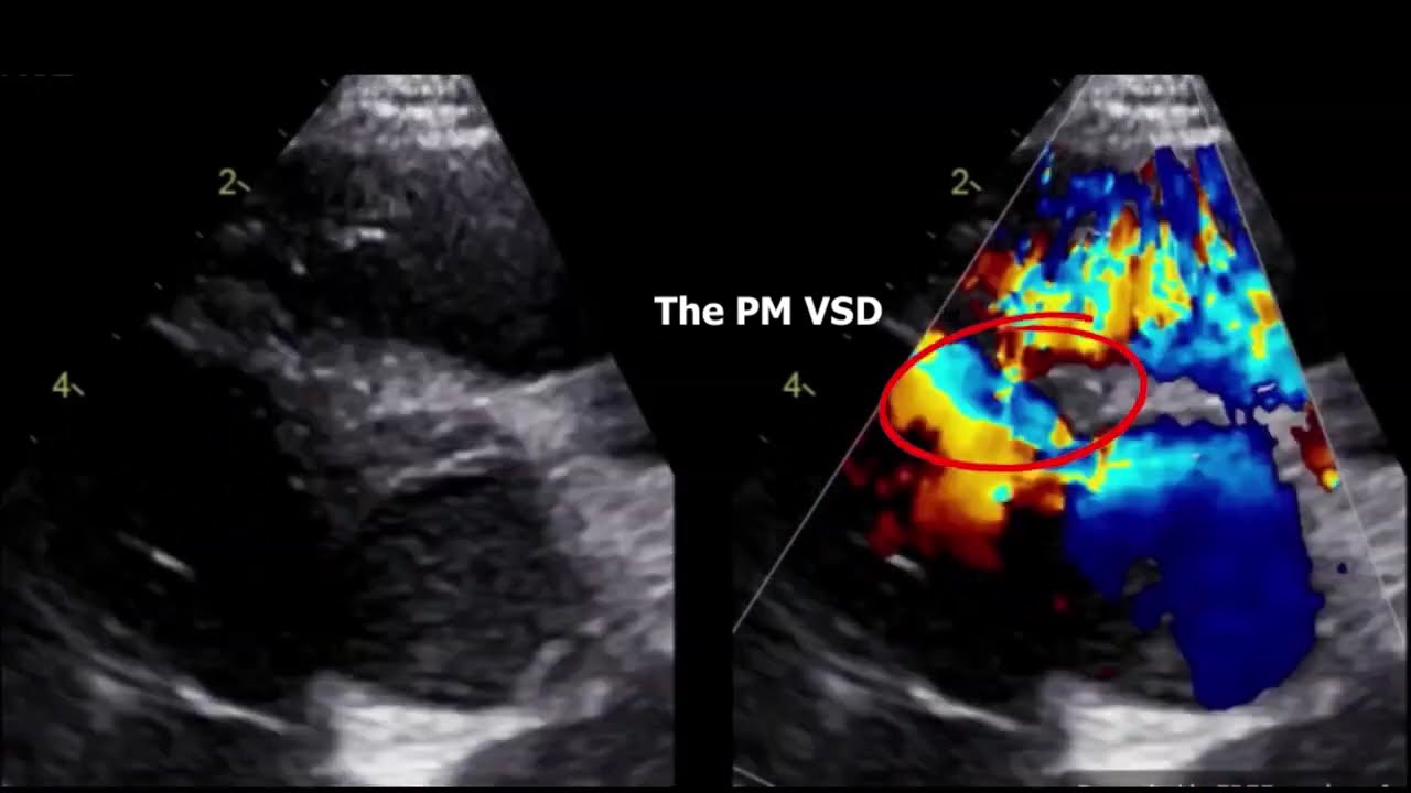 Double chamber right ventricle echocardiography (DCRV).