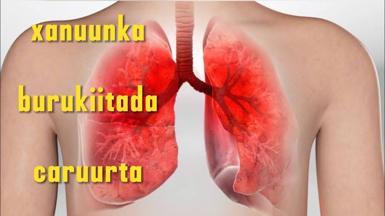 burukiitada caruurta Ku dhacdo calamadaha lagu garto iyo sida loo daaweyo cishirka 1AAD