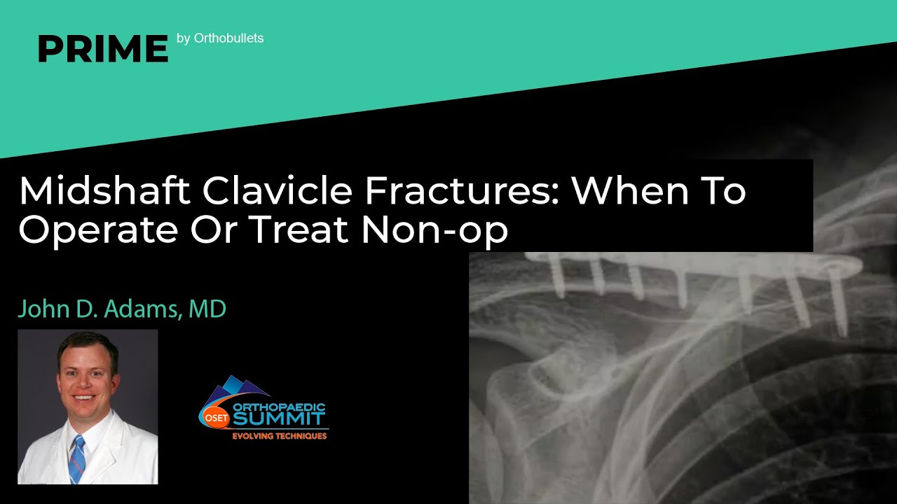 Midshaft Clavicle Fractures: When To Operate Or Treat Non-op - John D. Adams, MD