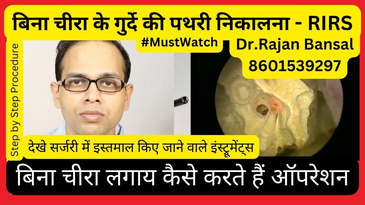 RIRS Procedure for Kidney Stone Removal ILaser Treatment for Renal Stones : Dr. Rajan Bansal - Hindi