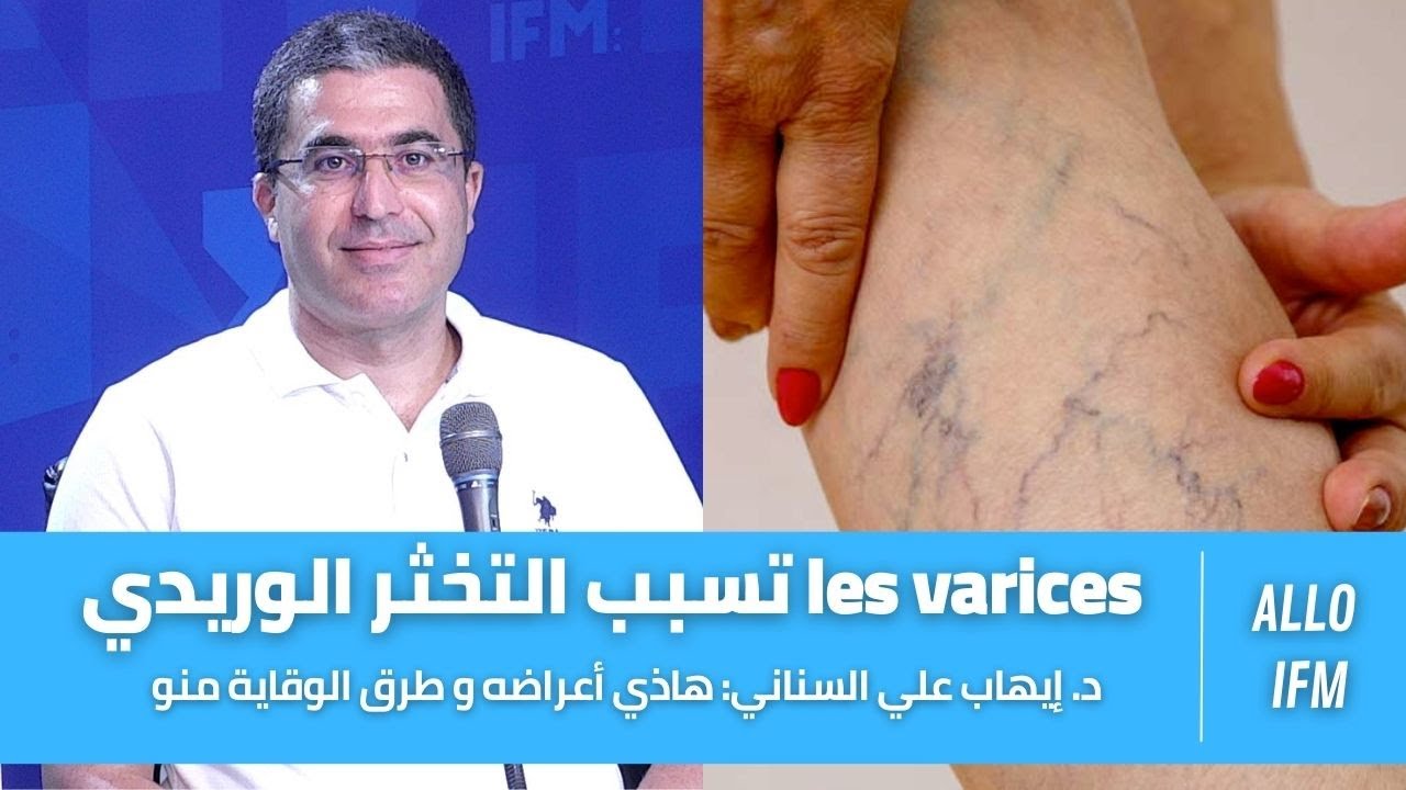 د. إيهاب علي السناني:  les varices تسبب التخثر الوريدي و هاذي أعراضه و طرق الوقاية منو