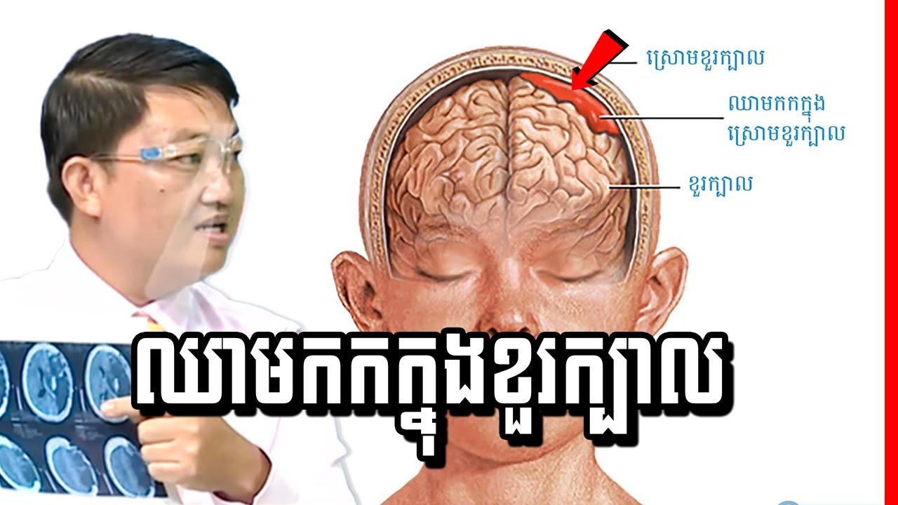 ឈាមកកក្រោមស្រោមខួរក្បាល , Subdural hemorrhage