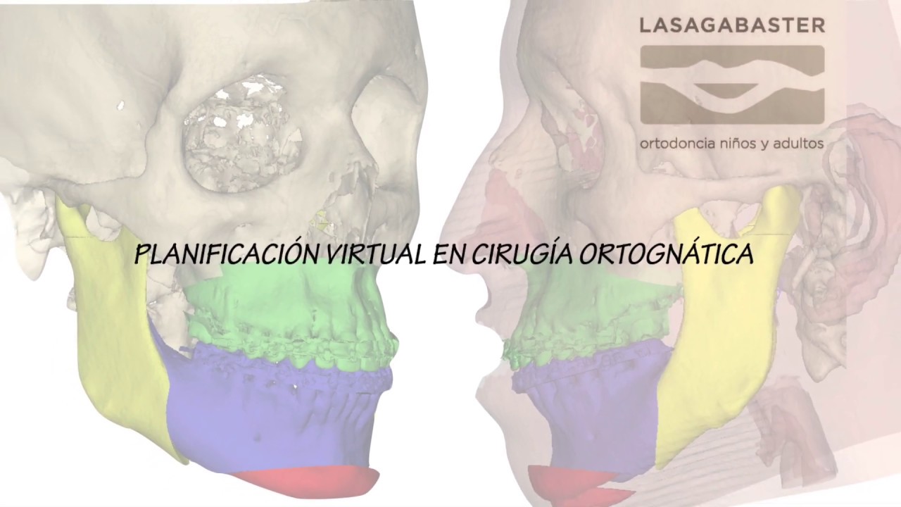 Planificaci&oacute;n Virtual en Cirugia Ortogn&aacute;tica