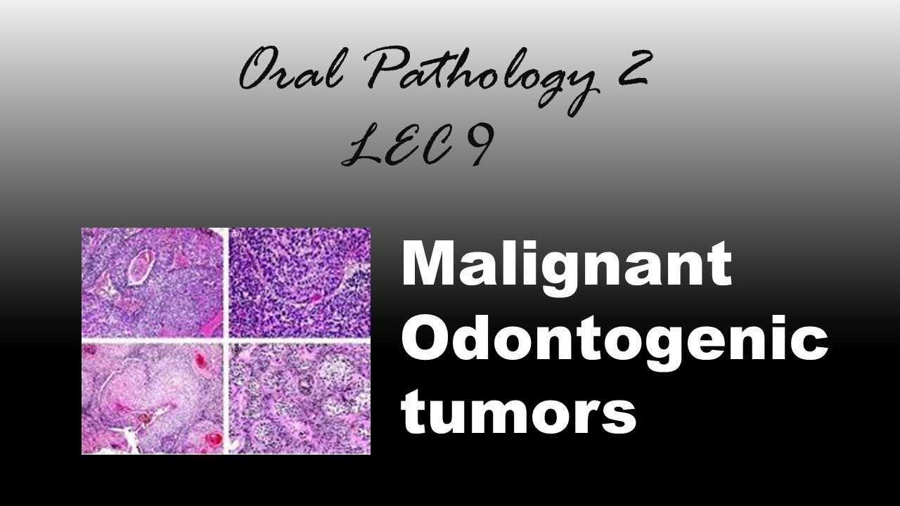 Oral Pathology 2 - LEC 9 Malignant odontogenic tumors