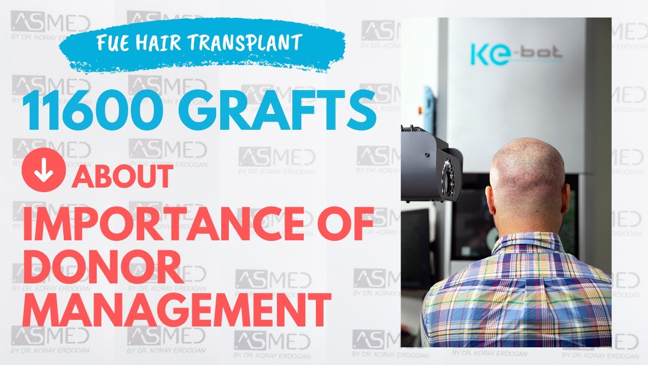 11600 графтов, управление зоной донор-Пересадка волос Мануальное FUE- клиника АСМЕД-Др.Корай Эрдоган