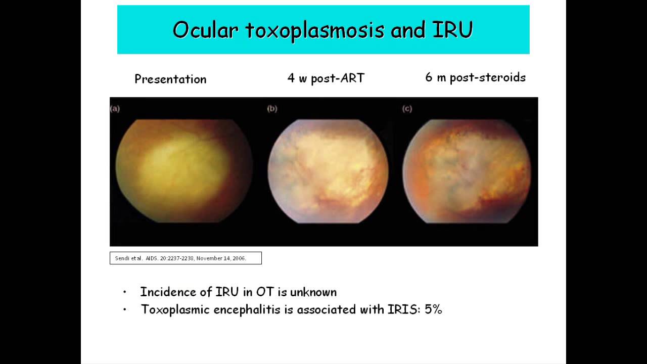 Infectious Retinopathies by Carlos Subauste, MD