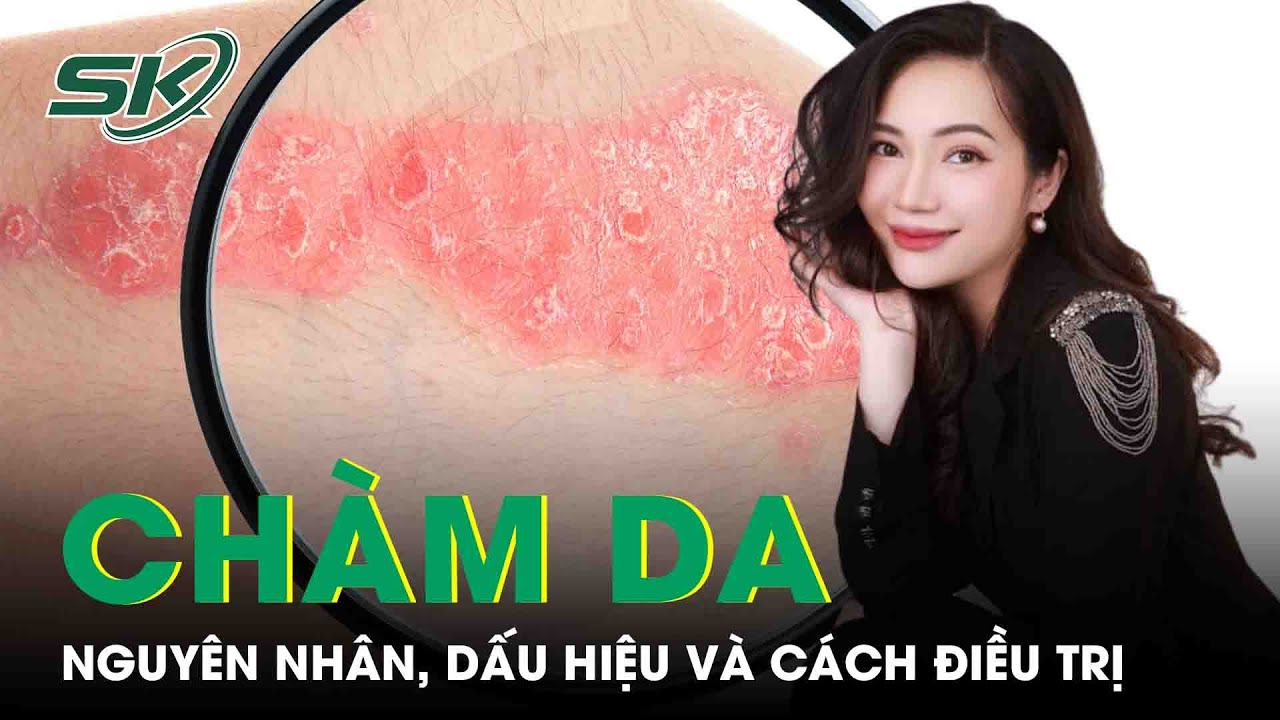 Chàm Da: Cách Điều Trị Thế Nào? Có Chữa Khỏi Được Không?| SKĐS
