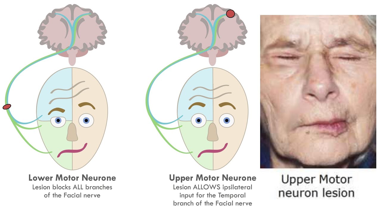 ACUPUNCTURE FOR UPPER MOTOR NEURON PARALYSIS