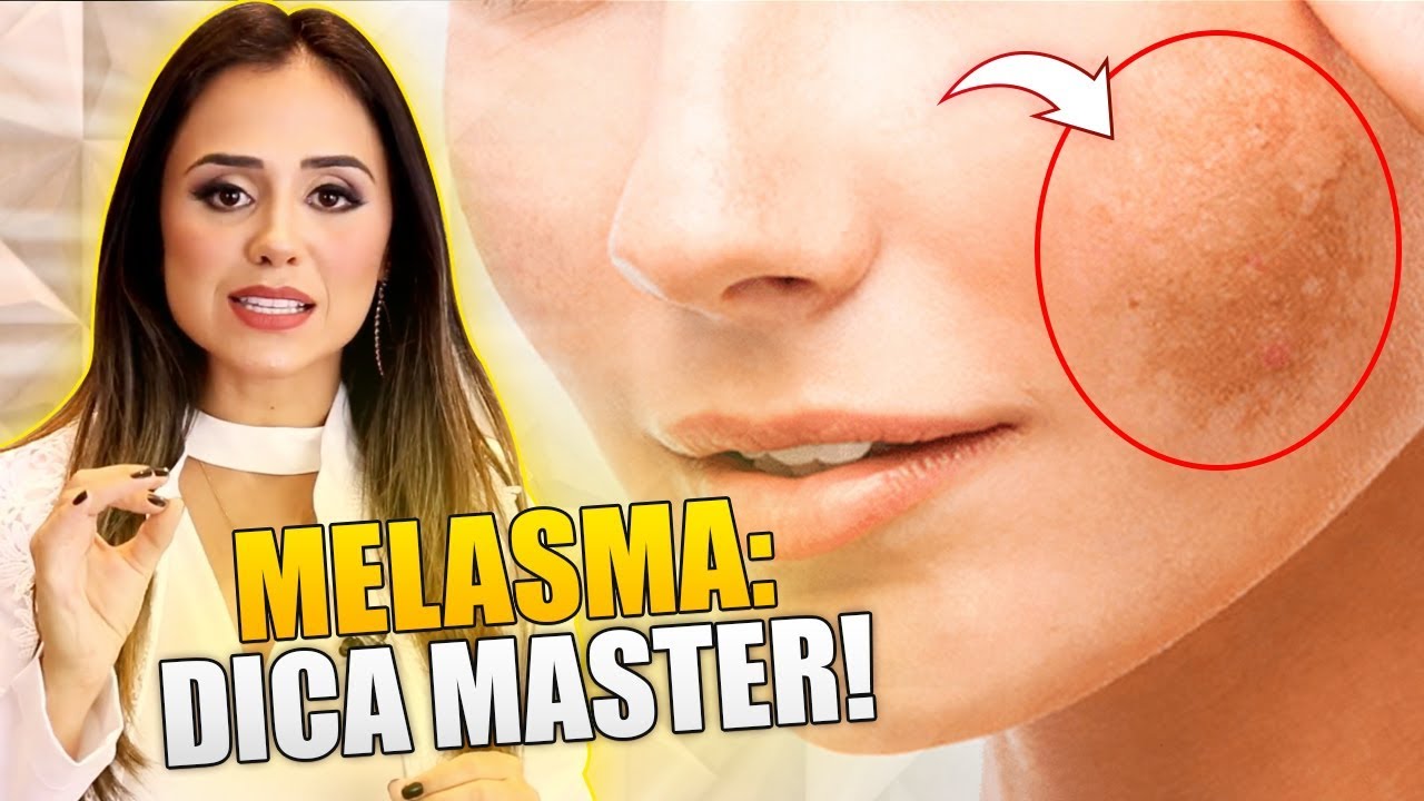 MELASMA: DICA FÁCIL, SIMPLES E INFALÍVEL PARA DIMINUIR E ACABAR COM O MELASMA (COMPROVADO)